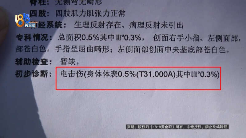 心疼!5岁男童触碰空调机瞬间被电晕 筋都断了(图)